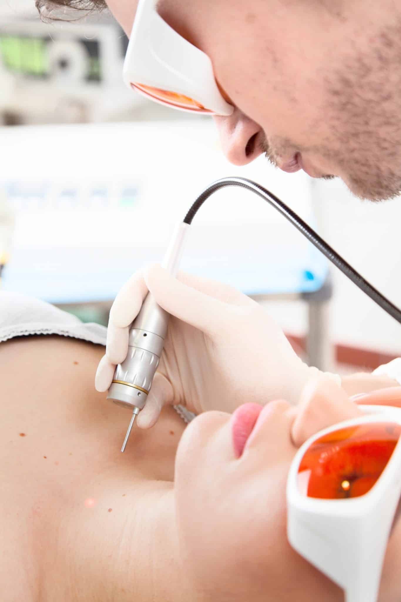 Rejuvenecimiento facial con láser CO₂ fraccionado