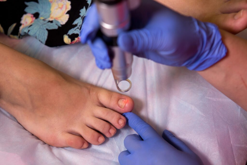 Aplicación de láser diodo 980 nm para onicomicosis sobre la uña afectada por hongos.